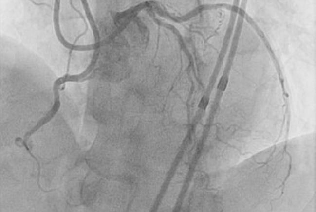 EuroCTO CASTLE: Prediction Model for CTO PCI Success Shows Good Discriminating Ability