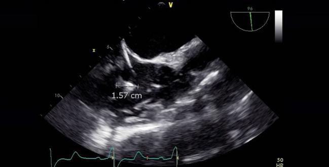 Incidental Thrombi on Device Leads Common, but Seemingly Innocuous