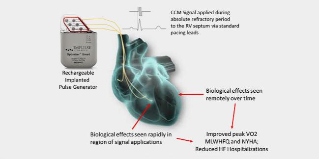 FDA Approves the Optimizer Smart Implantable Pulse Generator for Heart Failure