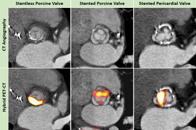 Could PET Imaging Be the ‘Game Changer’ for Detecting and Predicting Bioprosthetic Valve Degeneration? 