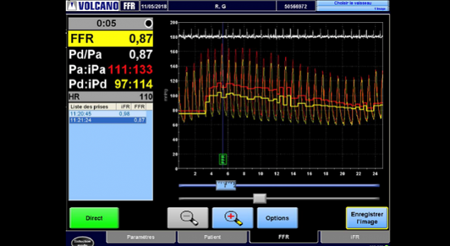 High Rate of Residual Ischemia After PCI Despite Excellent Angiographic Outcomes: DEFINE-PCI