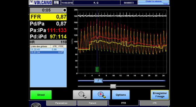 High Rate of Residual Ischemia After PCI Despite Excellent Angiographic Outcomes: DEFINE-PCI 