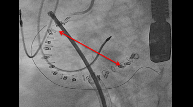 Cardioband Reduces Severe Tricuspid Regurgitation at 6 Months, With Good Safety: TRI-REPAIR