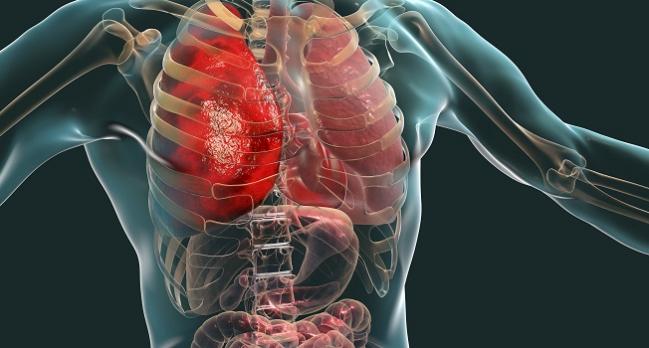 Organ Failure in Patients With Acute MI and Shock Is Prevalent and Rising