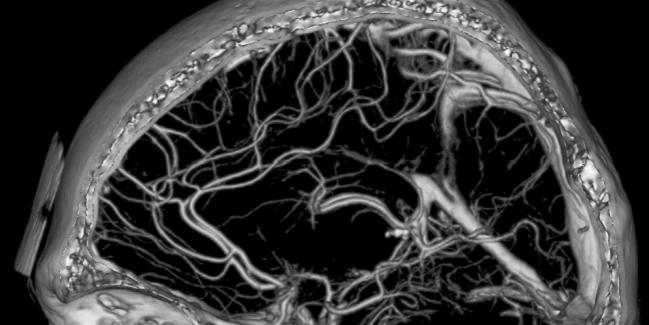 https://stock.adobe.com/images/computed-tomography-angiography-of-the-brain-vessels/4926020