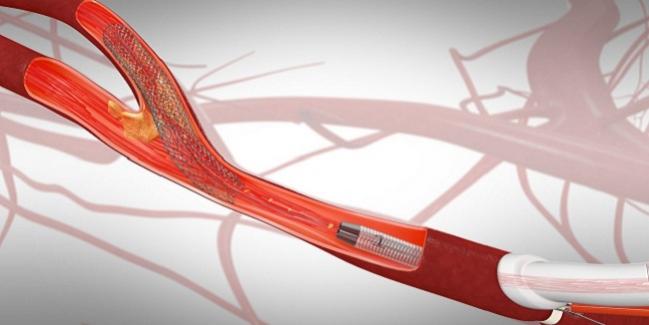 TCAR Use Growing for Carotid Stenosis as Positive Data Continue to Accumulate