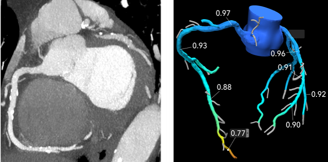 Rapid-Access CT Model Seeks to Increase Efficiency, Reduce Delays for Chest Pain