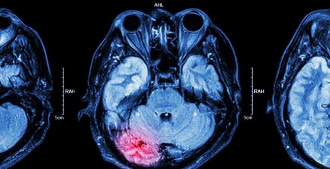 Real-world Stroke With TAVR: TVT Registry Insights Rekindle Cerebral Protection Debate