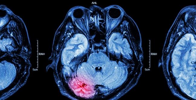 Real-world Stroke With TAVR: TVT Registry Insights Rekindle Cerebral Protection Debate 