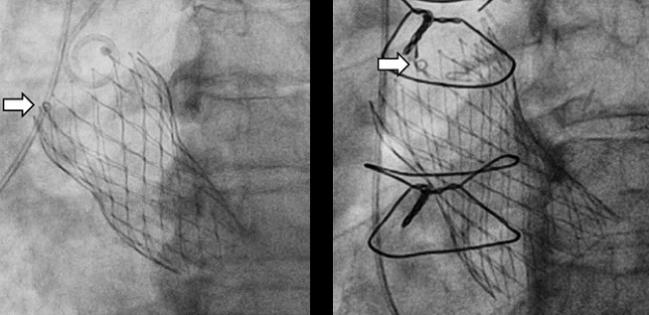 Evolut Valves: Initial Positioning Can Be Optimized for Future Coronary Access