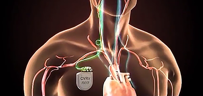 FDA Approves Baroreflex Activation Therapy Device for Advanced Heart Failure