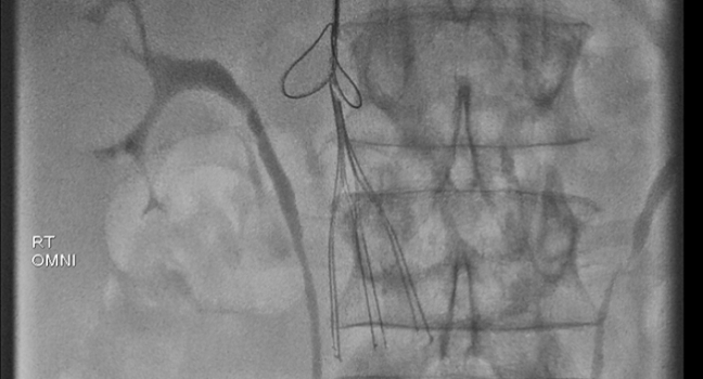 Use of IVC Filters for DVT Peaked in 2010 but Remains High