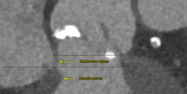 MIDAS Touch: Anatomic Strategy Dramatically Lowers Pacemaker Rate With Evolut Valves  