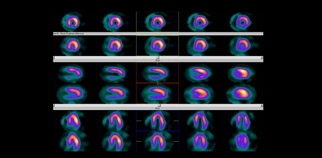 STICH Myocardial Viability at 10 Years: Still No Link With CABG Effects