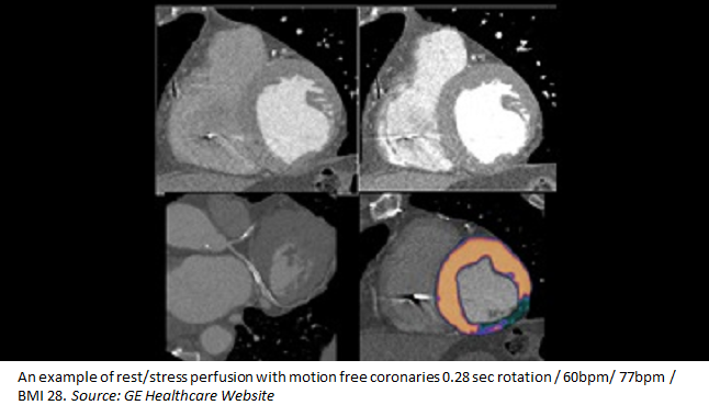 CT Perfusion Imaging for In-Stent Restenosis Shows Promise 