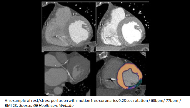 CT Perfusion Imaging for In-Stent Restenosis Shows Promise