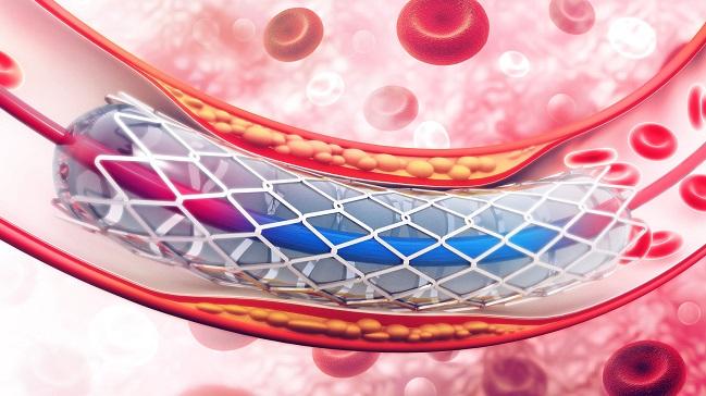 More Acute Stent Thrombosis With Synergy Stent in Bern PCI Registry