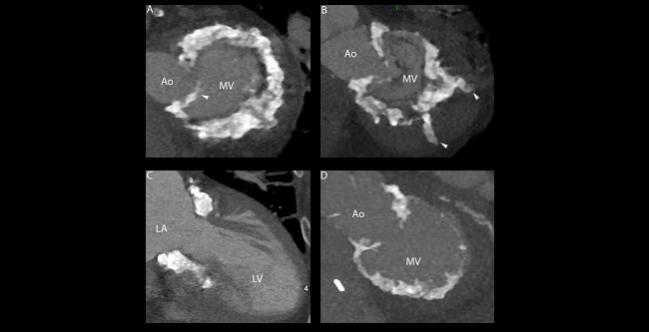 Early Signs Positive for Tendyne TMVR in Severe MAC