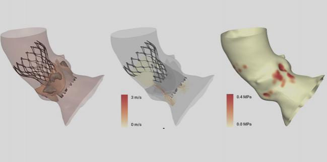 Personalized CT-Derived Modeling Guides Choices in Bicuspid Aortic Valve Disease