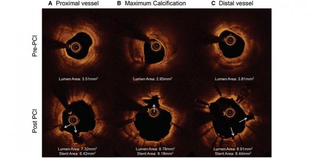 Intravascular Lithotripsy Shows Good Safety at 30 Days: DISRUPT CAD II