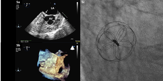 Better Closure, More A-fib With Cardioform for PFO Closure: Retrospective Series