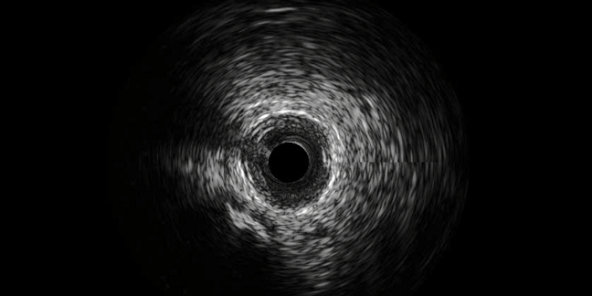 IVUS-XPL at 5 Years Shows Durability of Imaging Guidance in PCI