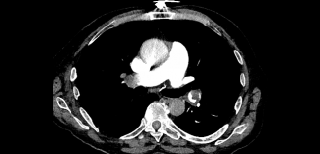 Interventional Options and Future Directions for Acute PE: New AHA Statement