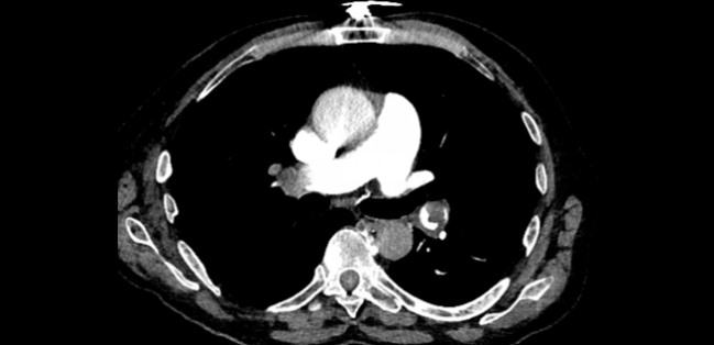 Interventional Options and Future Directions for Acute PE: New AHA Statement 