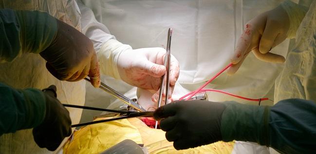 Multiarterial CABG ‘Underused’ in Contemporary Practice, Decreases Mortality