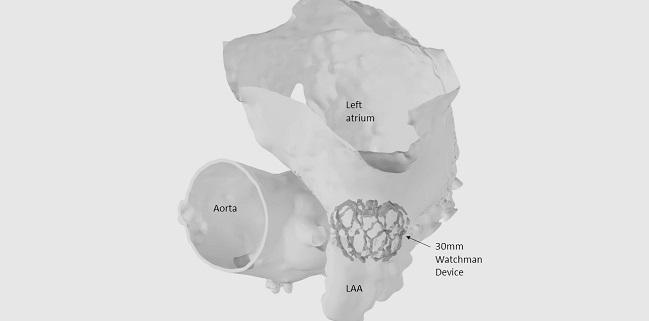 Expert Consensus Aims to Promote Cardiac CT Use in Preprocedural LAA Occlusion