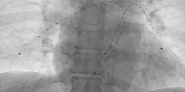 Future Pulmonary Embolism Interventions: Wild West or Working Together?