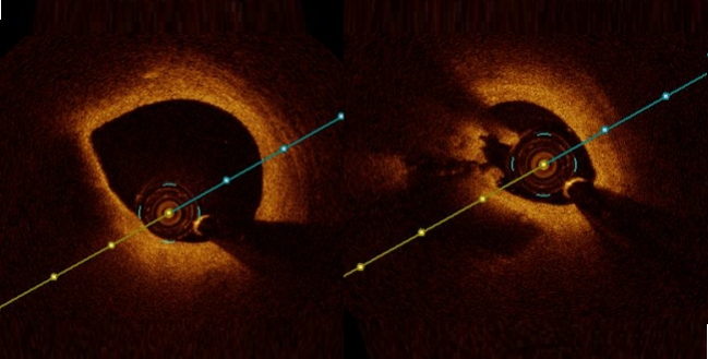 Complete Revascularization Benefits May Be Due to Stenting Vulnerable Plaques