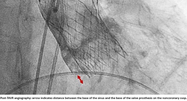 Optimal Implantation Depth With Self-Expanding TAVR? Success May Prove Elusive 