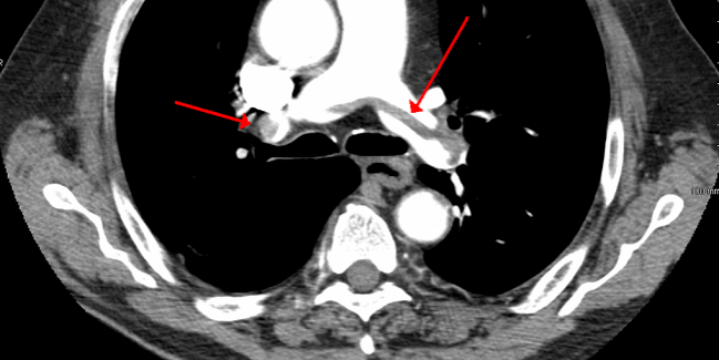 Overuse of CT Scans for Suspected Pulmonary Embolism Persists