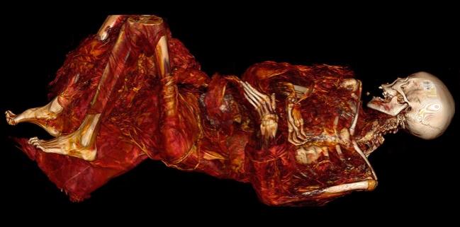 Atherosclerosis Seen in 500-Year-Old Inuit Mummies