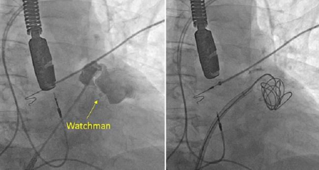 Embolization Coils May Be an Option for Leaks After LAA Occlusion