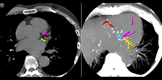 ‘Super-Dense’ Calcified Plaque Appears Protective Against ACS 