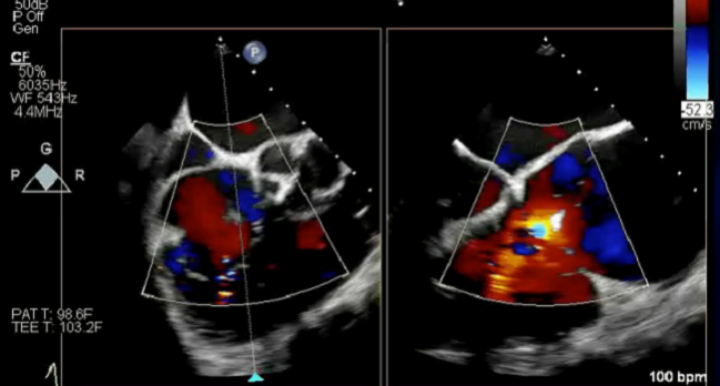 Tricuspid Interventions OK With Pacemakers, ICDs: TriValve Registry