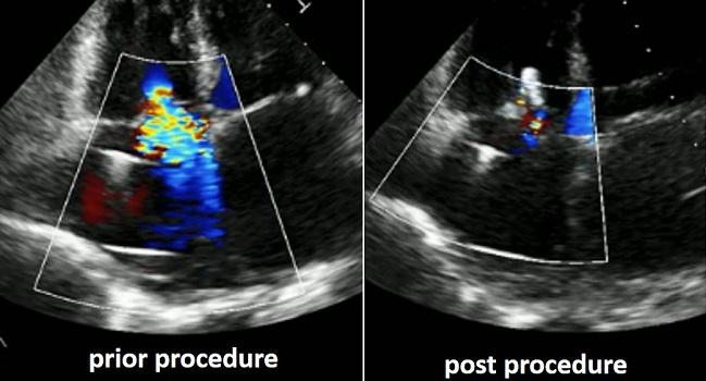 Transcatheter Tricuspid, Mitral Repair Appear Safe to Combine: Registry Data