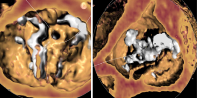 Positive Early Data for TAVR in Low-Risk Patients With Bicuspid Valves