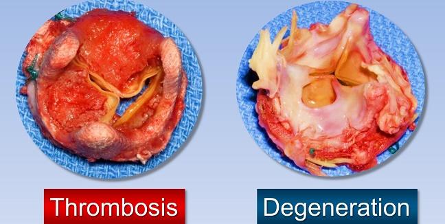 biological heart valve