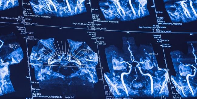 Combo of Proximal Protection, Double-Layer Stent May Enhance Carotid Stenting