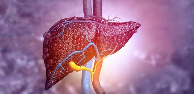 Cirrhosis Tied to Poor Outcomes in the Months After PCI