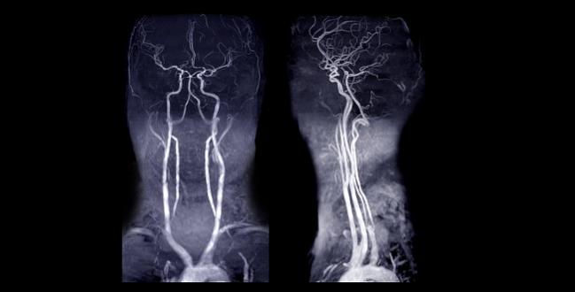 Stroke Thrombectomy for Basilar Artery Occlusions Gains Support: Registry