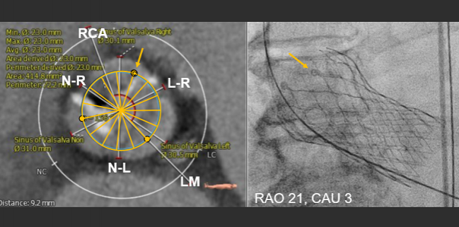 Preventing TAVR Obstruction of Coronary Arteries Remains a Challenge