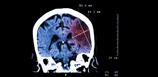 ‘Silent’ Brain Infarcts Common, Tied to Cognitive Decline in A-fib