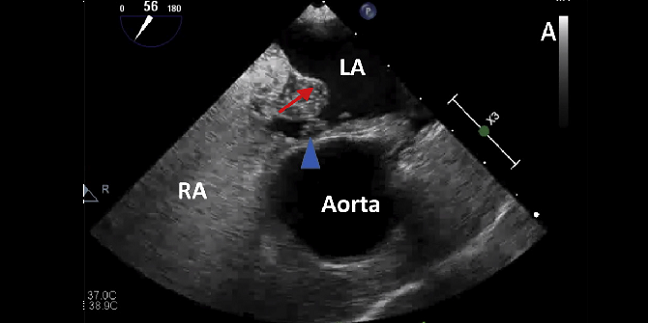 Atrial Septal Aneurysm, Not Shunt Size, Tied to Recurrent PFO-Related Stroke