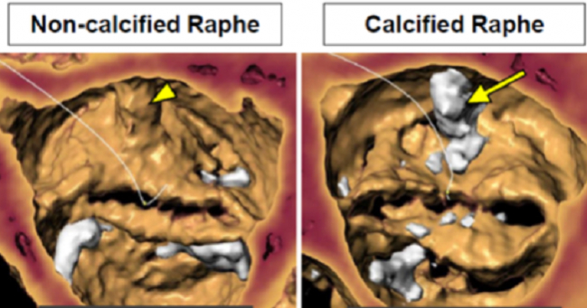 Good Results With Next-Gen, Self-Expanding TAVR in Bicuspid Valves