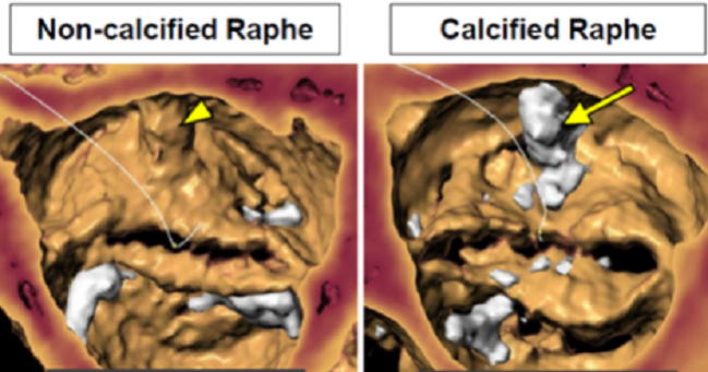 Good Results With Next-Gen, Self-Expanding TAVR in Bicuspid Valves 