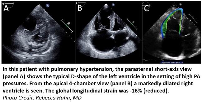 Role of strain echocardiography in patients with hypertension